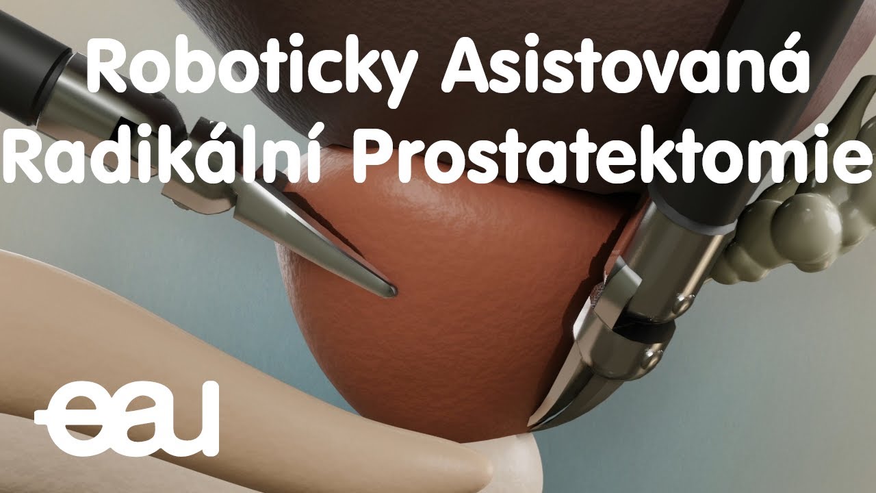 Roboticky Asistovaná Radikální Prostatektomie (Czech RARP)