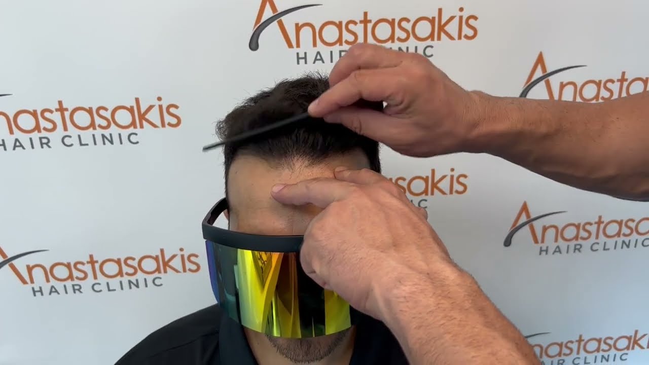 ⭐⭐⭐⭐⭐Case #219 - Δείτε το αποτέλεσμα με 3000 FUs - Anastasakis Hair Clinic