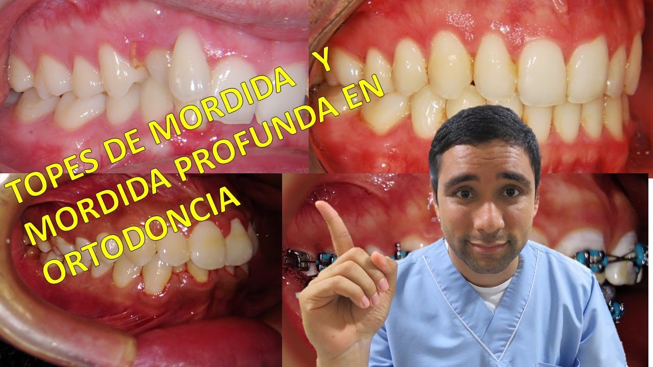 QUE SON los Topes de mordida ? como se usan para solucionar las MORDIDAS PROFUNDAS   en Ortodoncia?