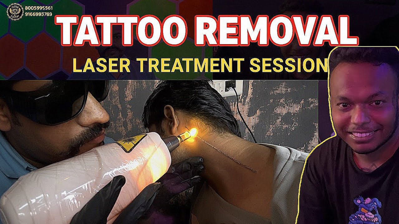  “Tattoo Removal Laser Treatment Session | Before & After Results”