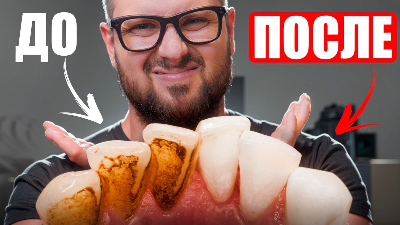 Зубной камень: что вы делаете неправильно