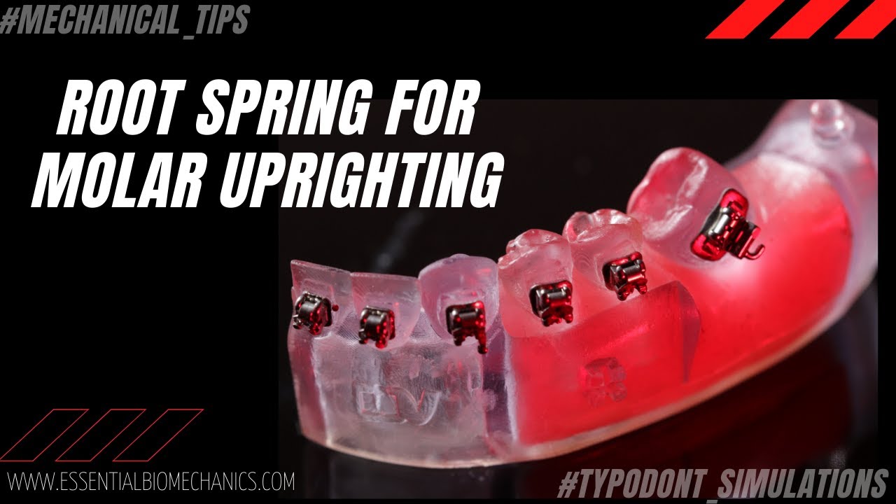 Root_Spring_for Molar_Uprighting | Essential Biomechanics