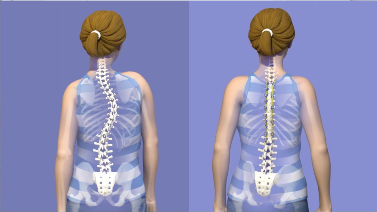 &iquest;En qu&eacute; consiste la cirug&iacute;a para la escoliosis?