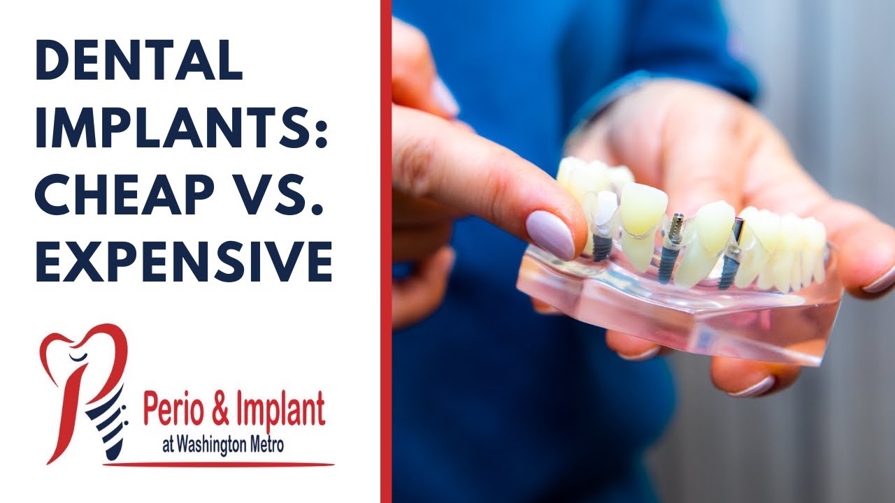 Dental Implants: Cheap vs Expensive