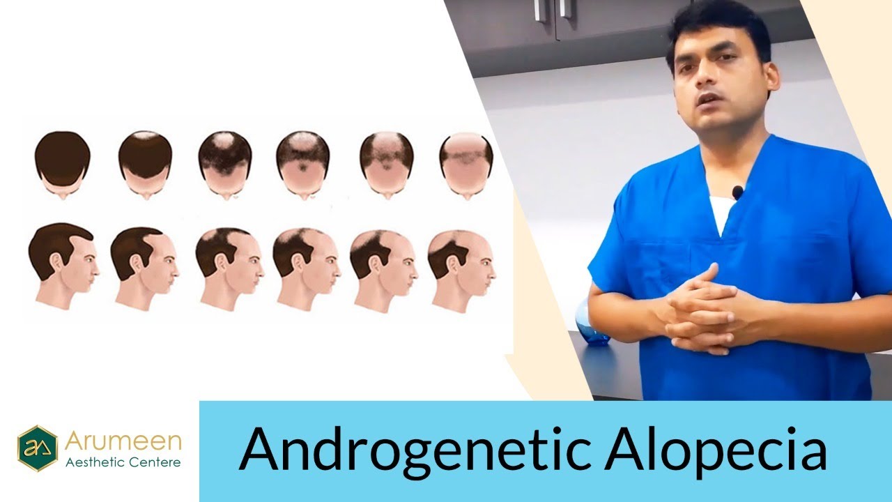 Androgenic Alopecia || Male pattern baldness || Hair loss MEN / Women -By Dr.A.Saravanan In Tamil