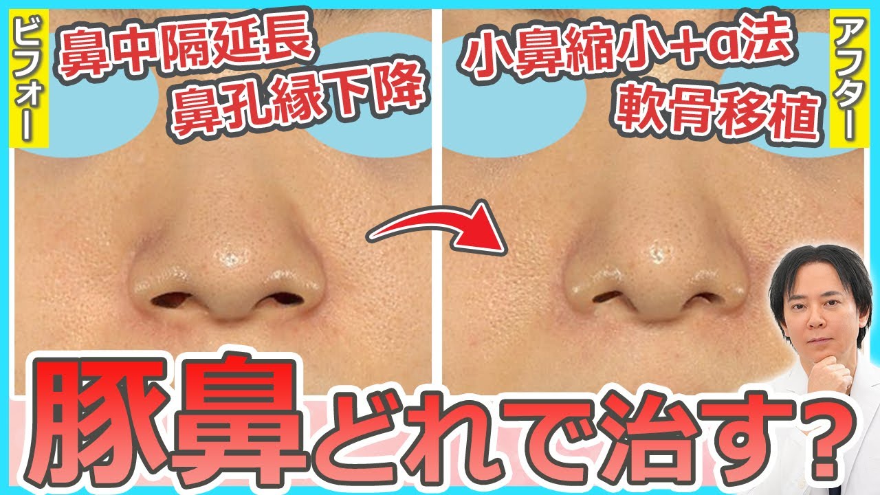 【鼻整形】豚鼻を治すにはどの美容整形を受けるべき？【鼻中隔延長・鼻孔縁下降・軟骨移植・小鼻縮小＋α法】
