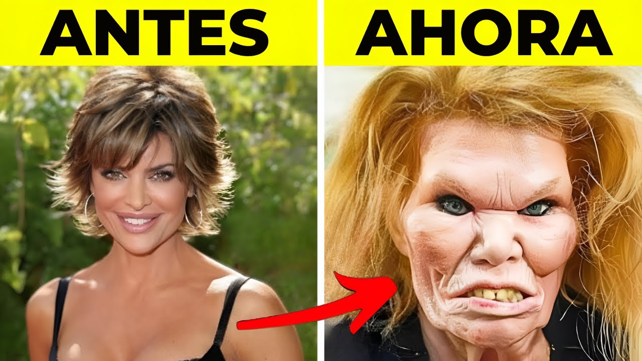 50 Estrellas de Hollywood Que ARRUINARON Su Rostro Con Cirugía Plástica | Antes y Ahora