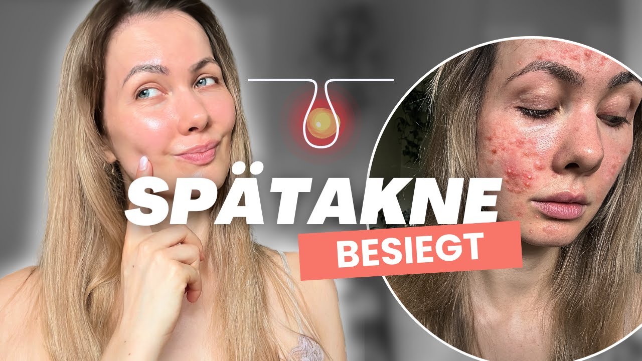 Die Lösung für Erwachsenen Akne! (So wurde ich pickelfrei ) | Spätakne loswerden