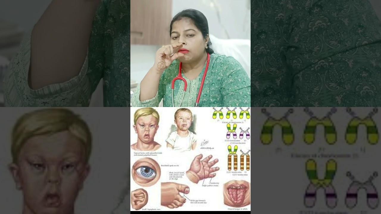 Down syndrome baby signs ll #M&MHospital #Dr.Mandakinee