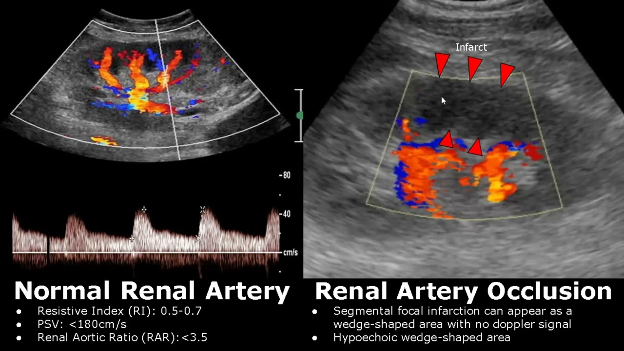 Renal Artery Doppler Ultrasound Normal Vs Abnormal Images | Stenosis/Occlusion/AVM | Kidney USG