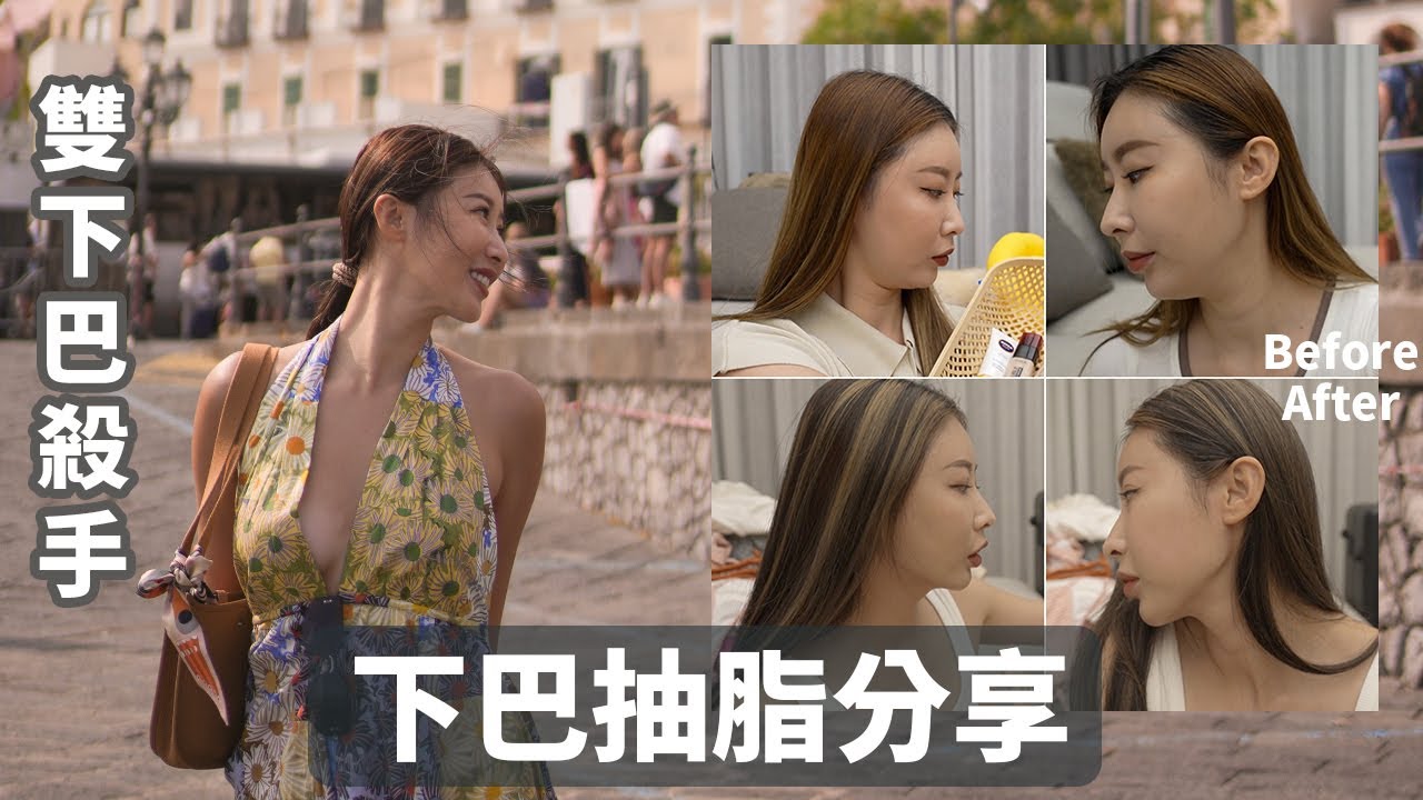 超值得！擺脫雙下巴最有感最直接的下巴抽脂手術