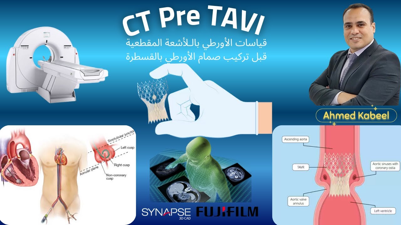 CT TAVI and Aortic Measurements قياسات الأورطي بالـلأشعة المقطعية قبل تركيب صمام الأورطي بالقسطرة
