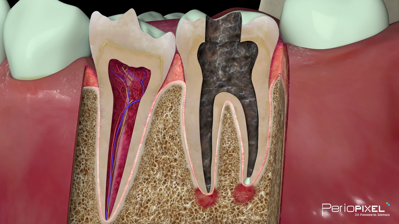 Vídeo 3D - Tratamiento de endodoncia en caries profundas