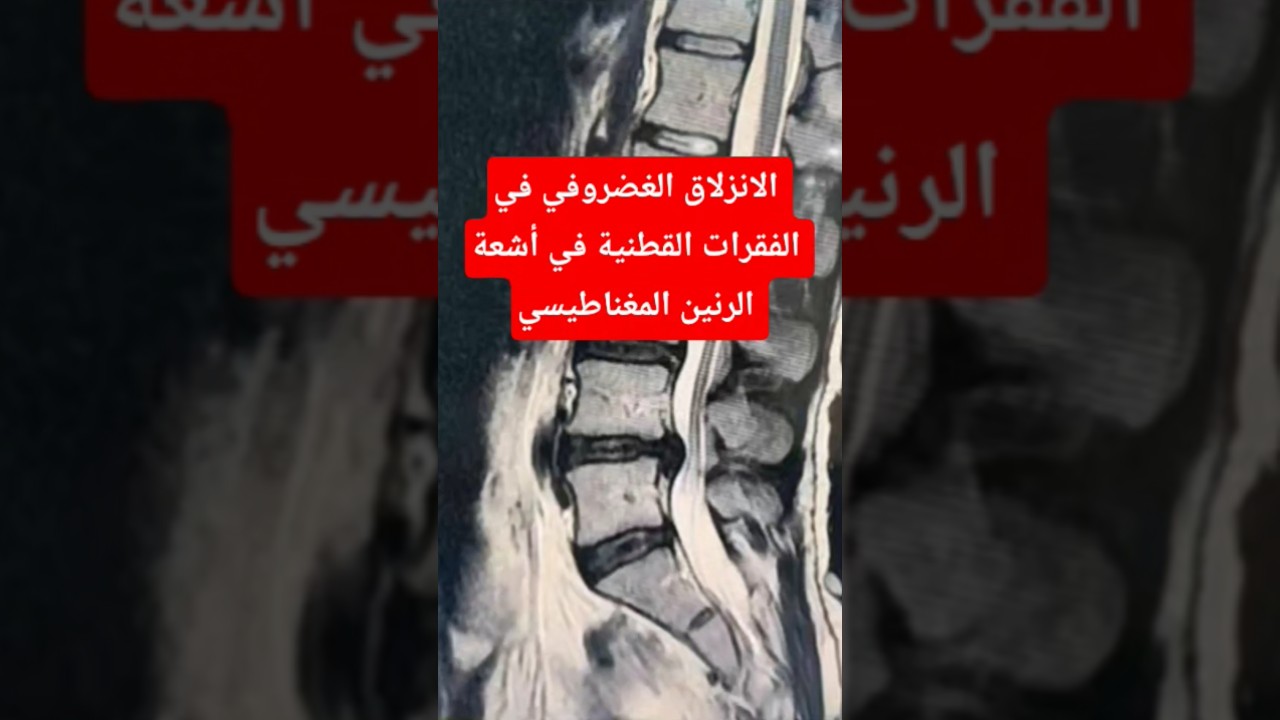 ازاى بيظهر الانزلاق الغضروفي في الفقرات القطنية في أشعة الرنين المغناطيسي