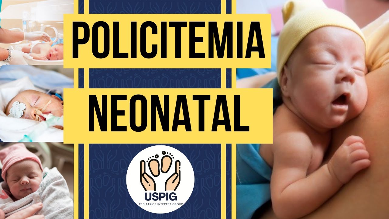 POLICITEMIA NEONATAL