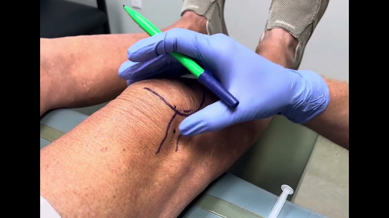 Knee injection using landmarks - Superolateral approach
