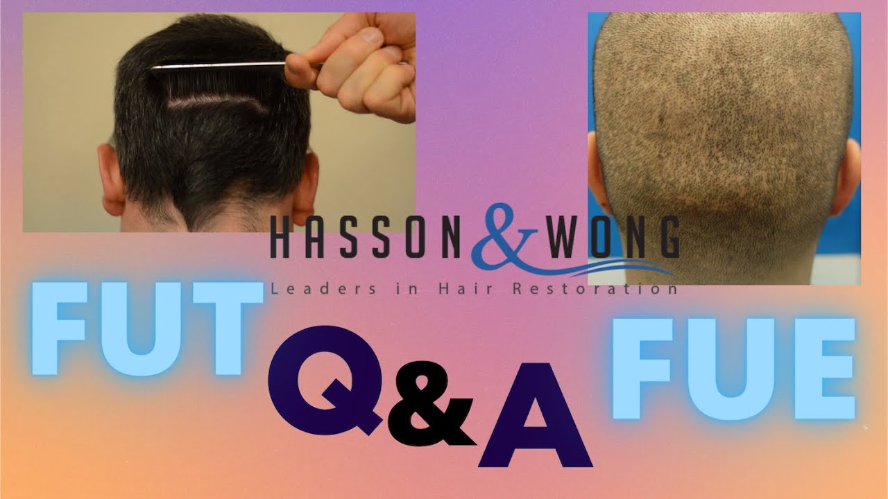 FUT or FUE Hair Transplant? *Q&A Hasson and Wong