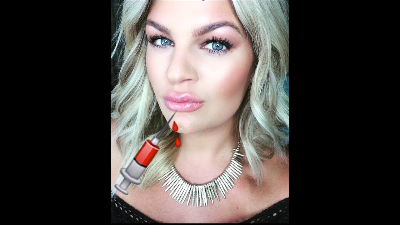 My LIP INJECTION Experience & DEMO/ Graphic
