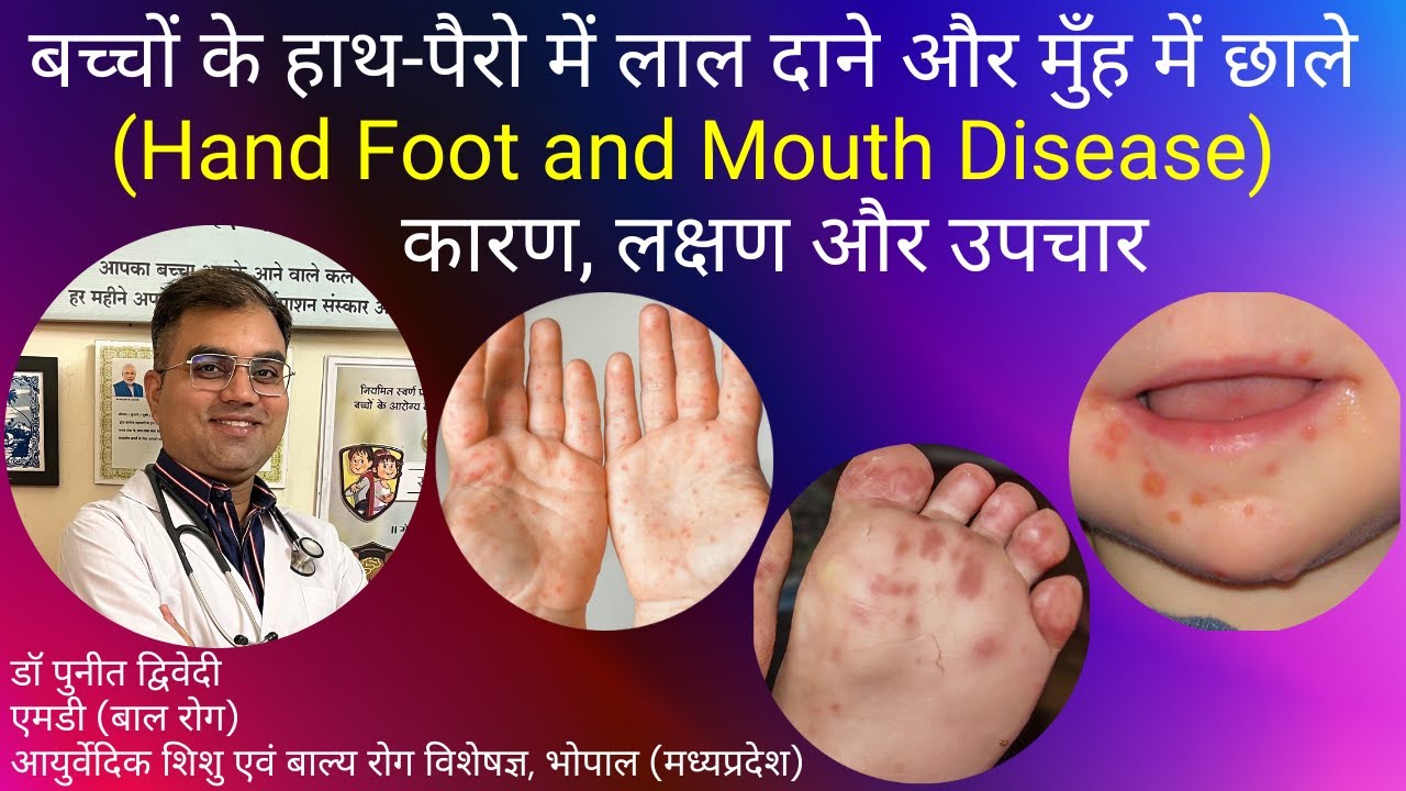 Hand Foot And Mouth Disease Treatment | डॉ पुनीत द्विवेदी