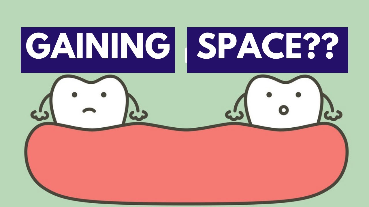 Methods for Space Gaining (Orthodontics)