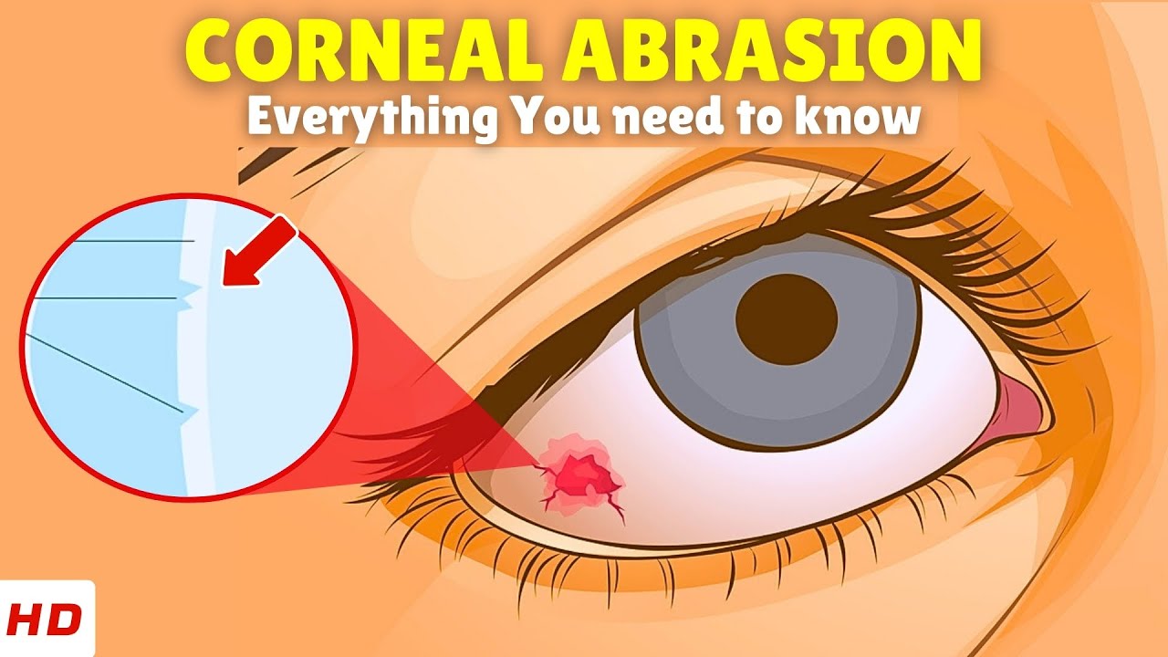 Corneal Abrasion (Scratched Eye) &ndash; Causes, Signs and Symptoms, Diagnosis & Treatment