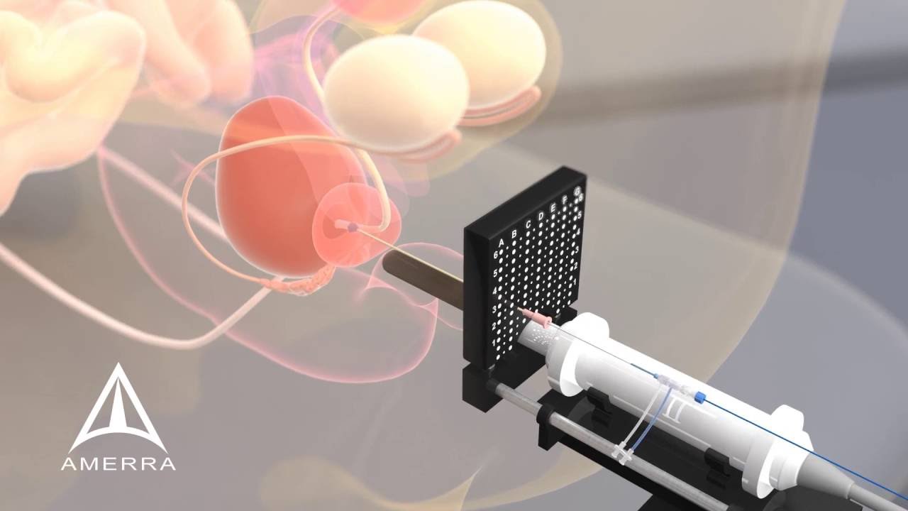 Nanospectra - Aurolase - 3D Medical Animation
