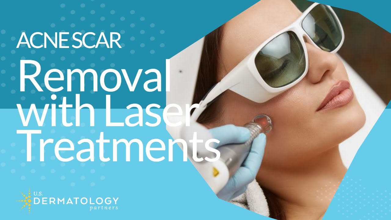 Acne Scar Removal with Laser Treatments