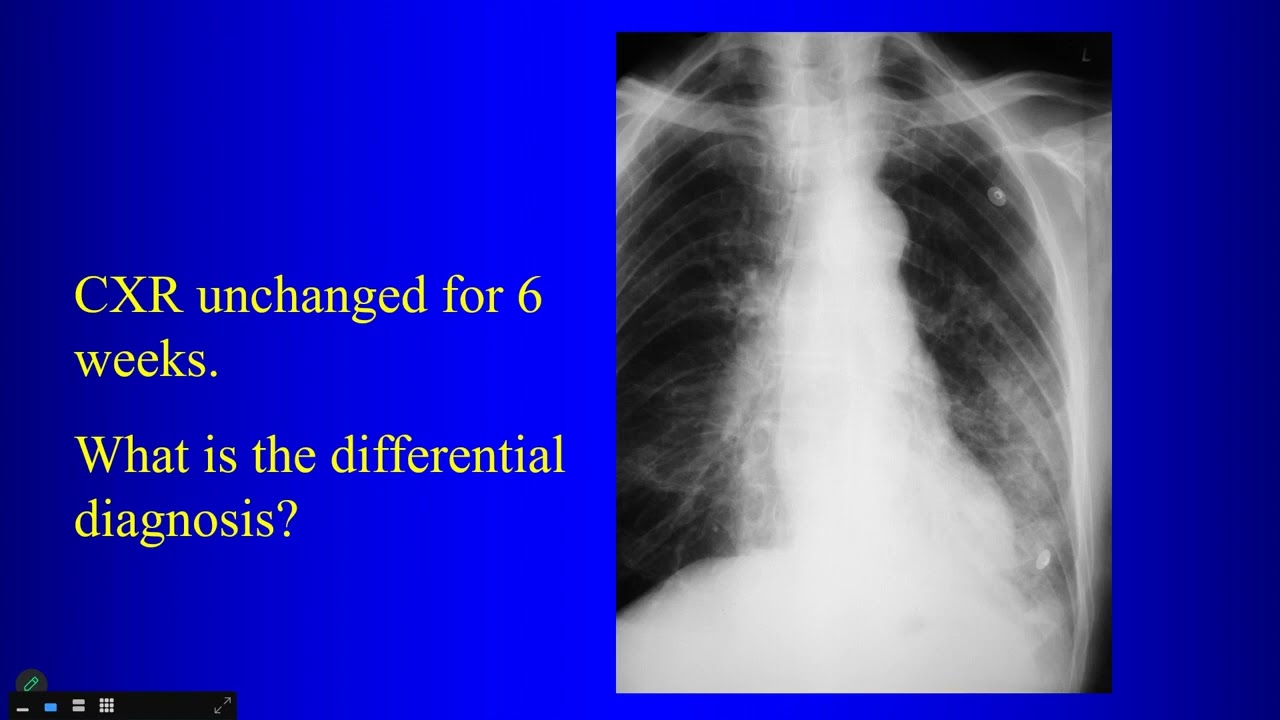 3 Radiology of Lung Cancer