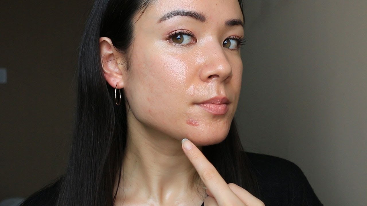 1 Year of Differin - SKIN UPDATE #3 | 