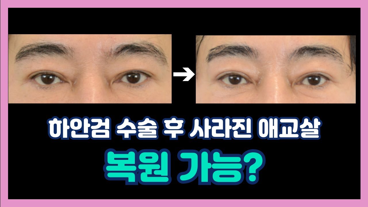 눈 밑 수술 후 생기 없는 인상… 애교살은 왜 사라졌을까? 남자 눈밑지방재배치!