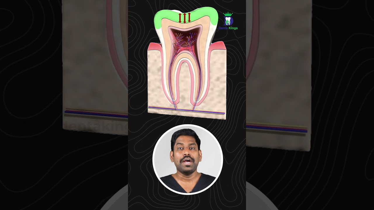 ஆபத்தான பல் சொத்தை எது? Take immediate action for this class V cavity. Dr.Karthikeyan | Denta Kings