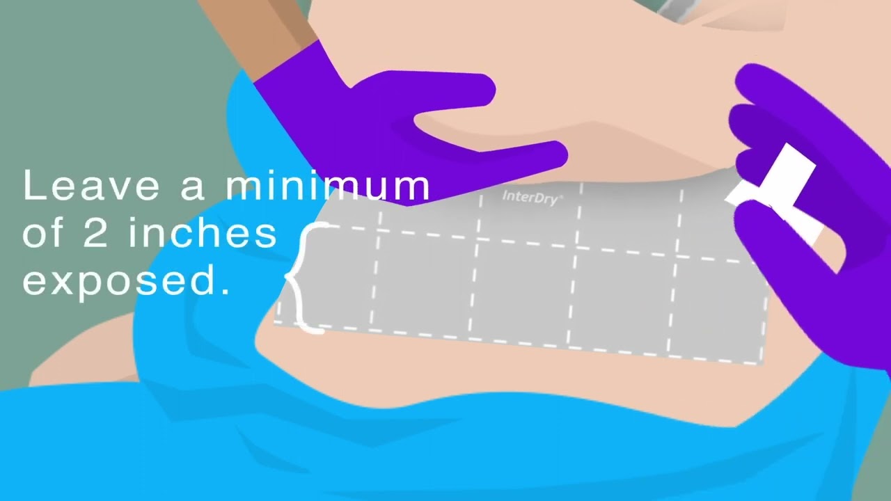 How to apply InterDry moisture wicking fabric in skin folds