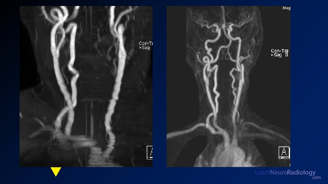 Neuroradiology board review 2 case 5