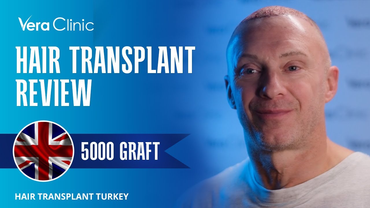 Hair Transplant Turkey Review 5000 Grafts #sapphirefue  #hairtransplantturkey #hairtransplantreview