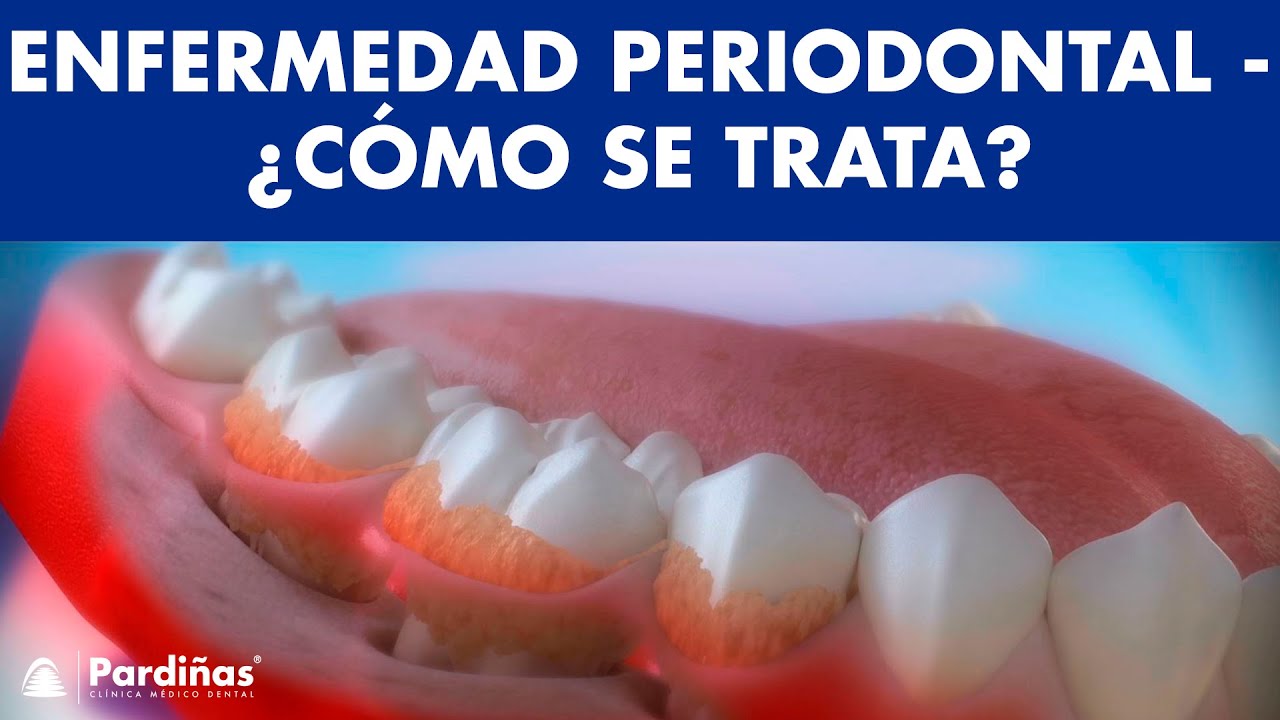 La piorrea o PERIODONTITIS - Efectos en la SALUD, tratamiento y SOLUCIÓN ©