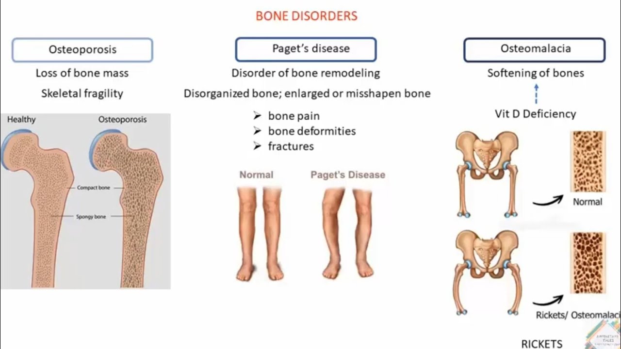 BONE DISORDERS AND TREATMENT