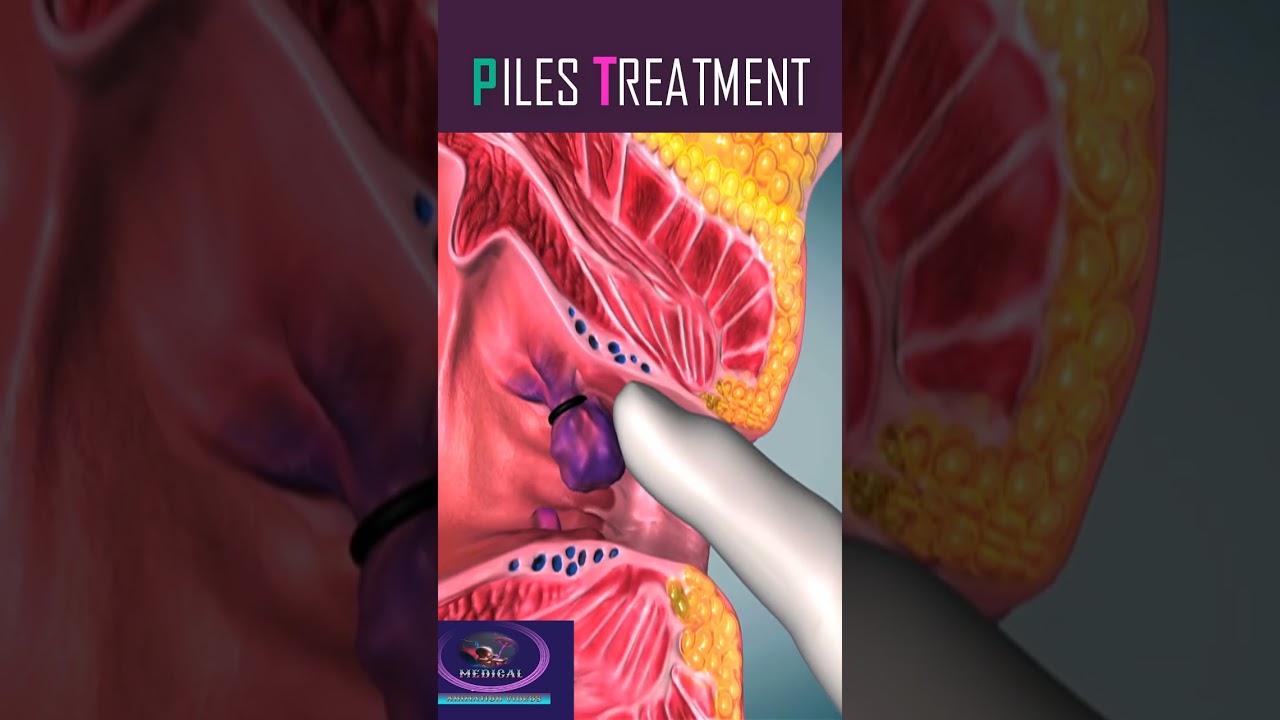 Piles Treatment #shorts #piles
