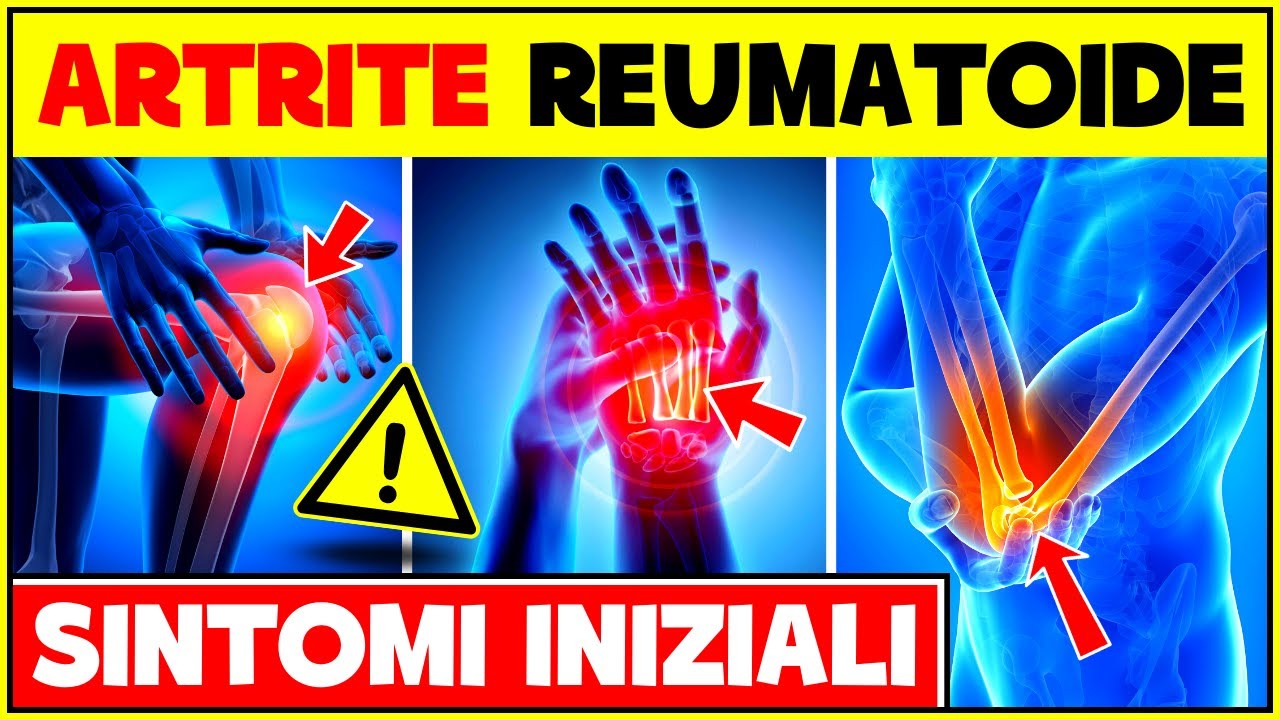 5 Segni e Sintomi Iniziali Dell'Artrite Reumatoide | Artrite Reumatoide: Sintomi Precoci