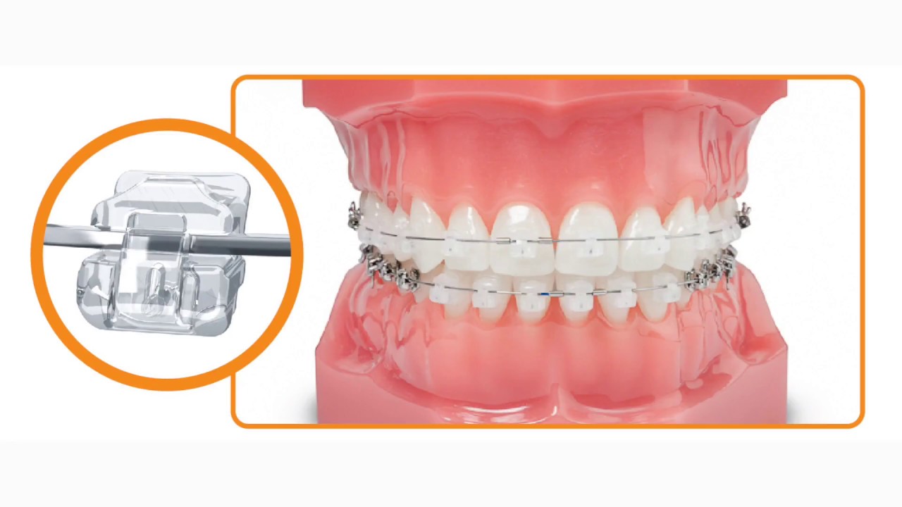 Which braces are better, Damon Clear or Damon Metal?