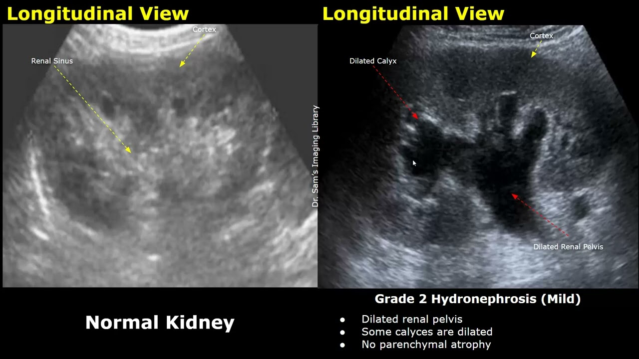 Ультразвуковое исследование для определения степени гидронефроза | УЗИ почек: нормальные и патоло...
