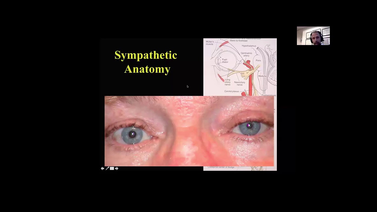 Pertinent Pupillary Problems 08/16/2016