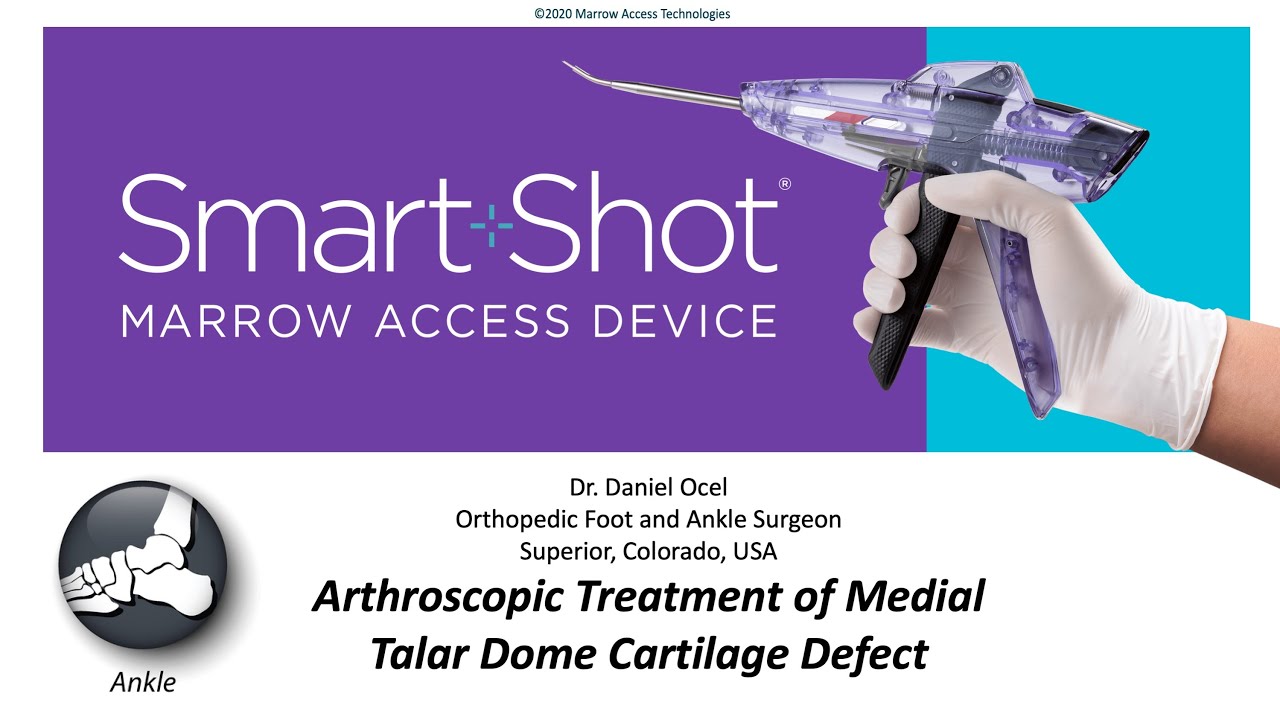 SmartShot Marrow Stimulation in the Talar Dome
