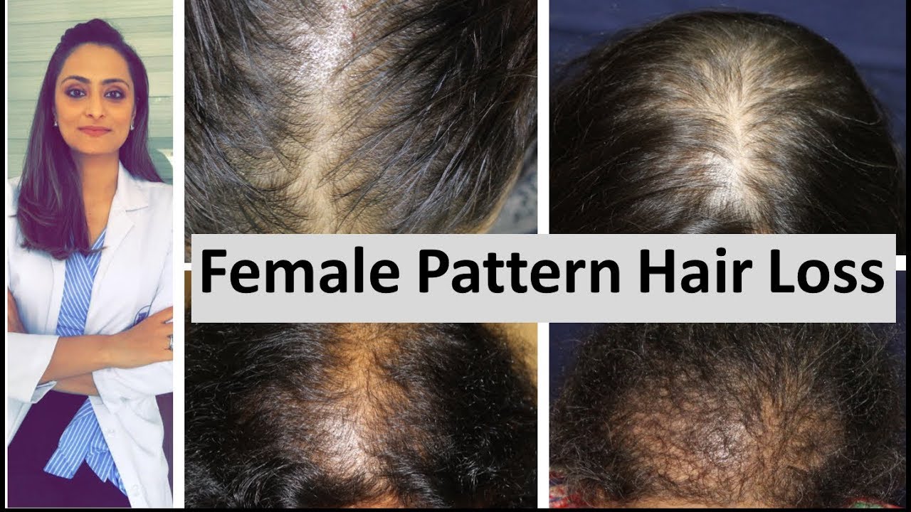 Hair loss in women | Female Pattern Hair Loss | causes & treatment | Dermatologist