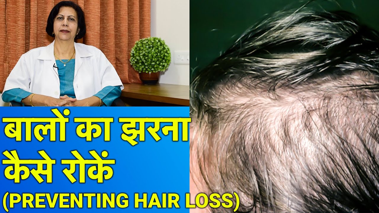 बाल झरना कैसे रोकें और उसका इलाज || Treatment of Hair Fall/Hair Loss