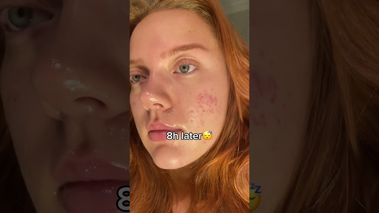 How to pop a pimple without scarring💙  #acneproneskin #acne