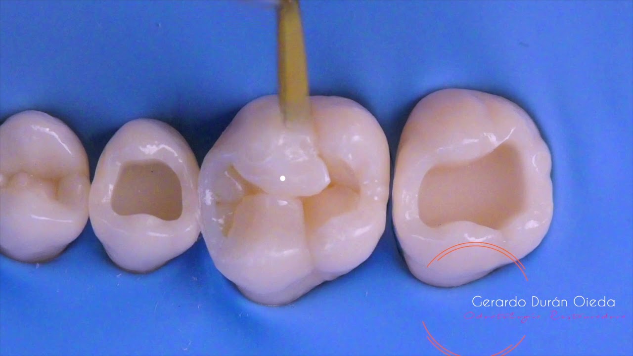 Direct Posterior Composite