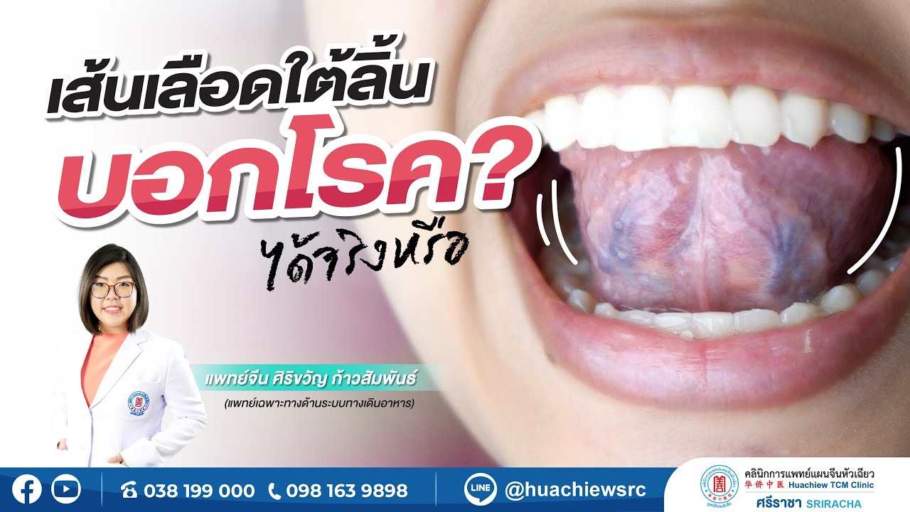 เส้นเลือดใต้ลิ้นบอกโรคได้จริงหรือ ⁉️