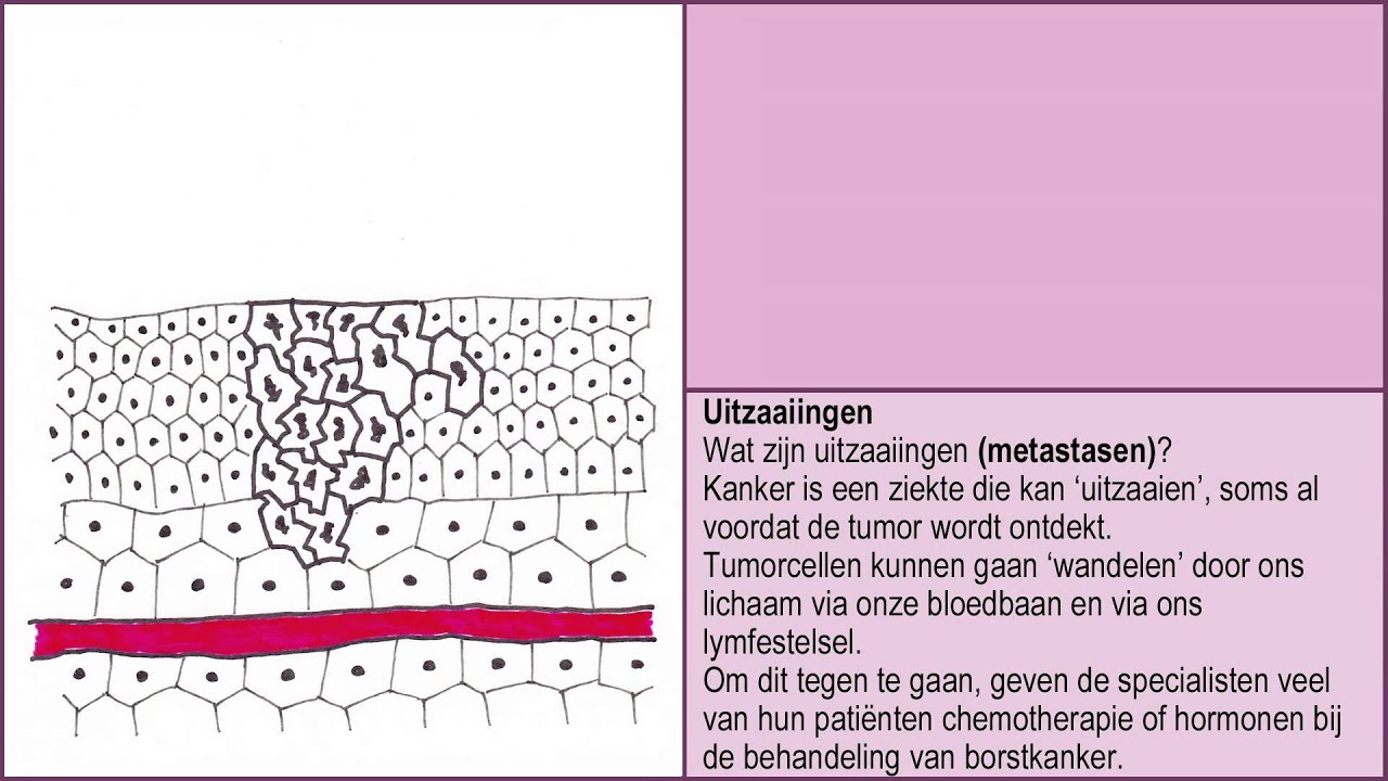 Wat als je niet meer beter wordt? - Uitzaaiingen en dan 1/6