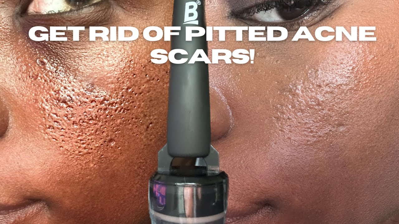 HOW TO GET RID OF PITTED ACNE SCARS!
