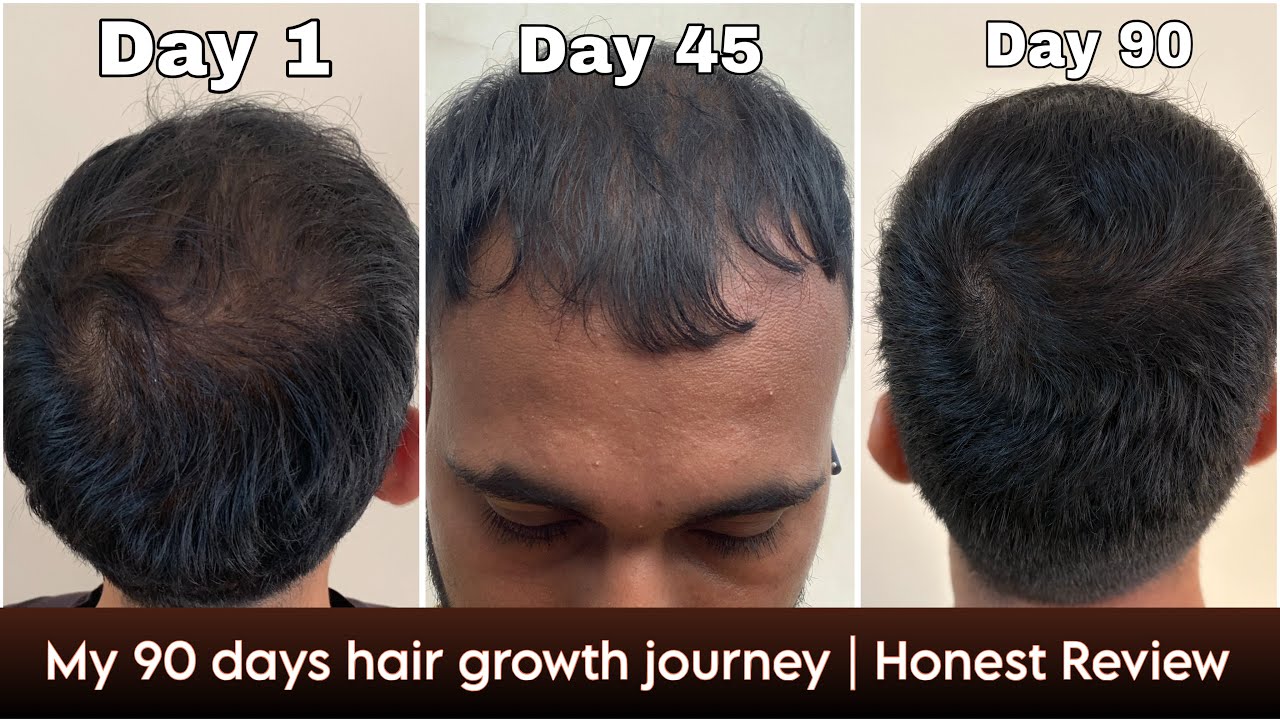 Adon Hair Care Kit 90 Days Honest Review 😳 | Real Hair Regrowth Results (Before & After)